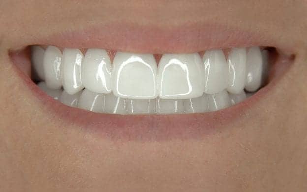 Incredibil™ Veneers gapped teeth client after
