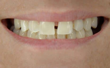 Incredibil™ Veneers gapped teeth client before