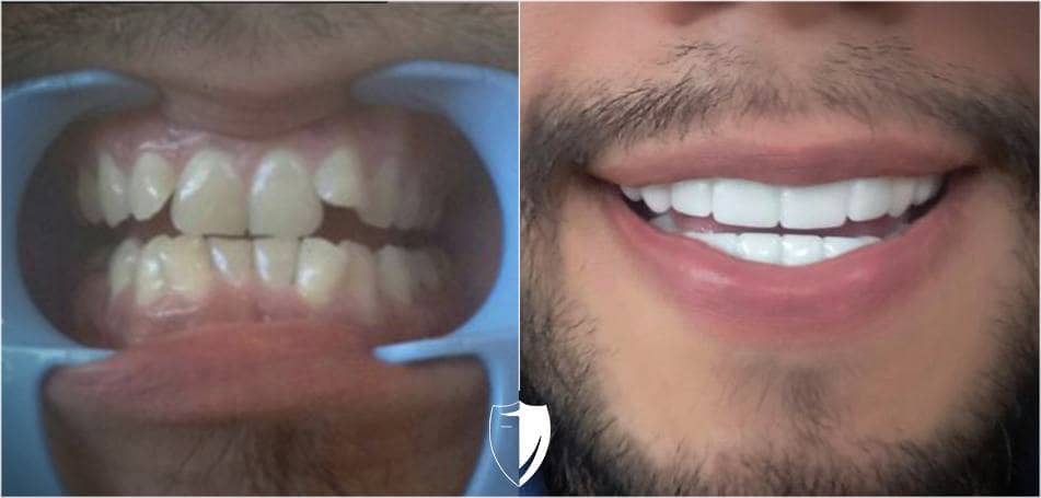 Bil Veneers made him smile, and Brighter Image Lab can do it for you