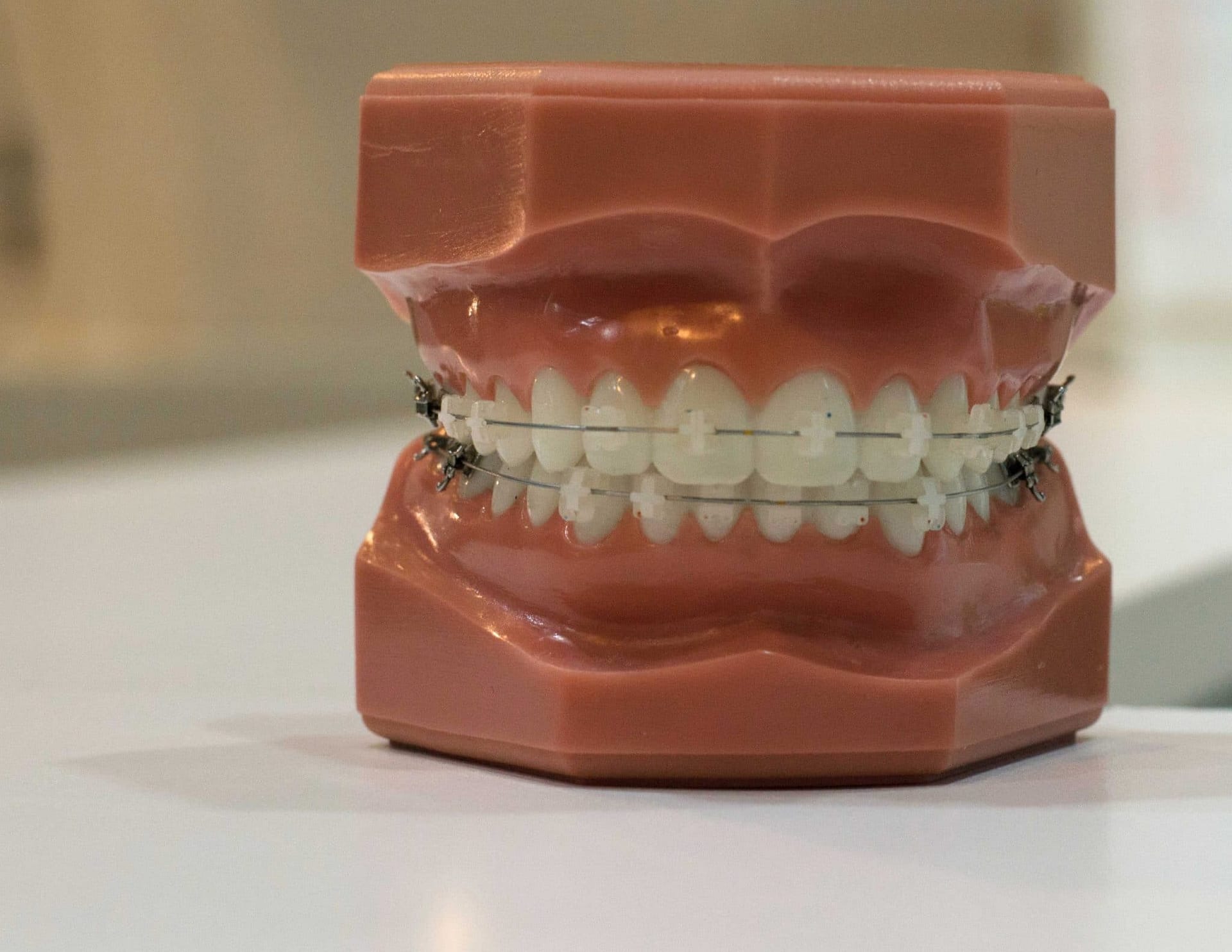 braces-sample