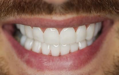 Brighter Image Lab Short Teeth Client After