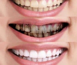 charcoal toothpaste dental hygiene
