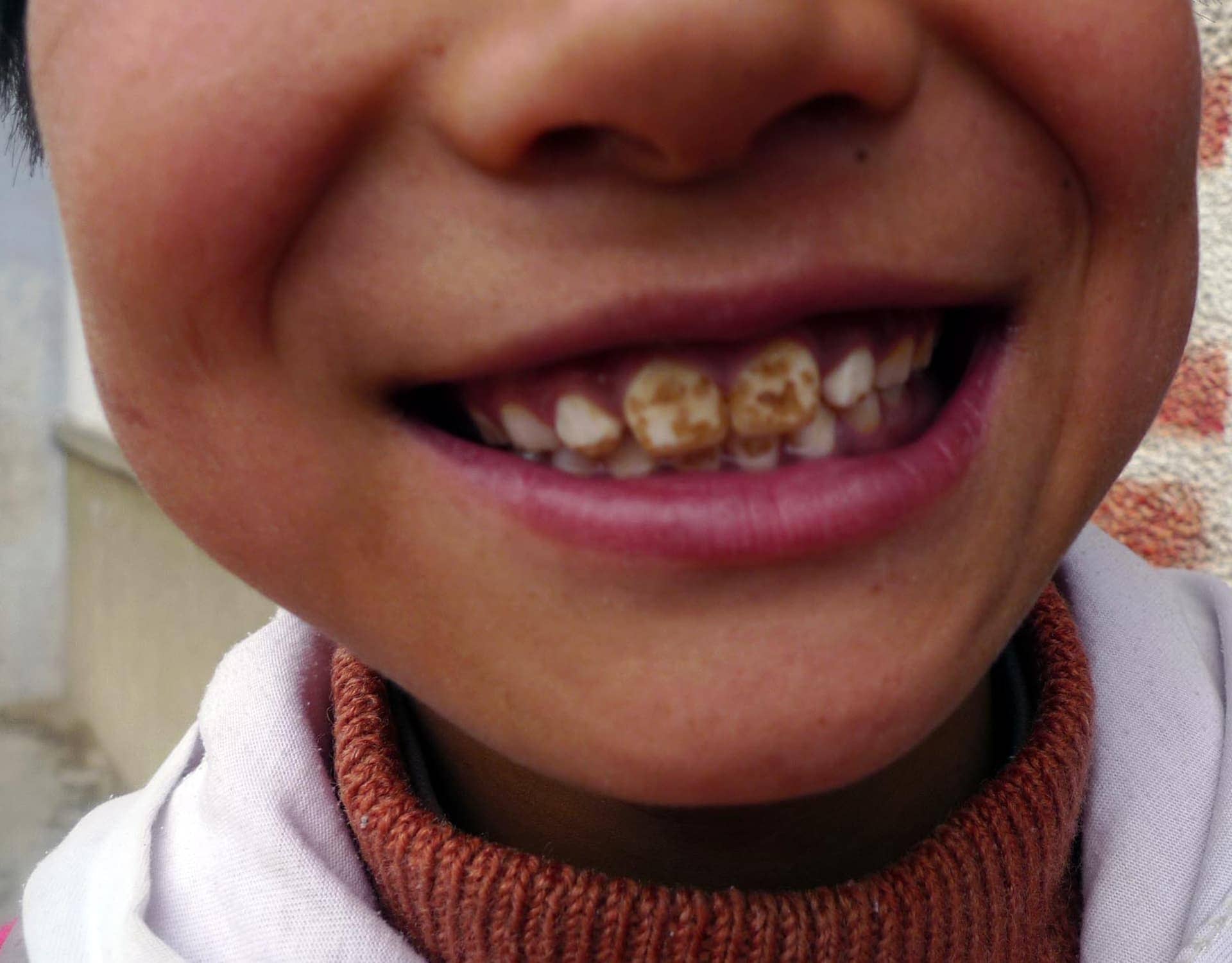 Fluoride Causing Health Issues? Is Our Water Safe? Fluoride Causing Health Issues