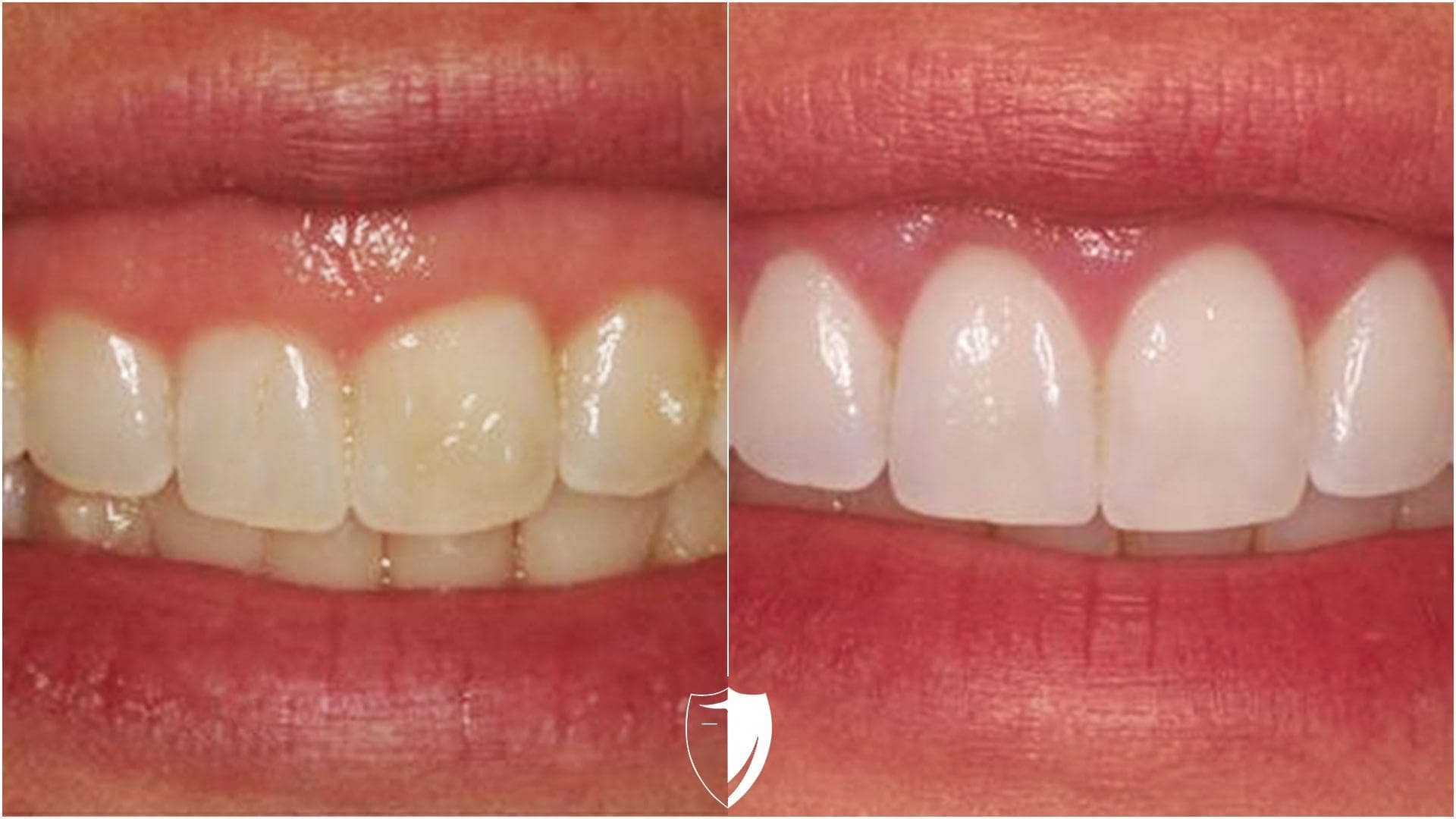 Client photo before and after gum contouring